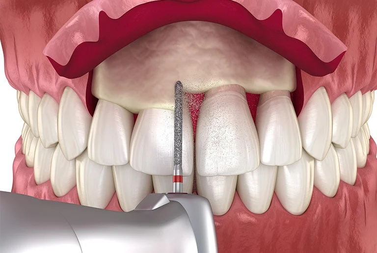 Gum Treatment Near You